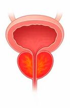 A prosztata gyulladása